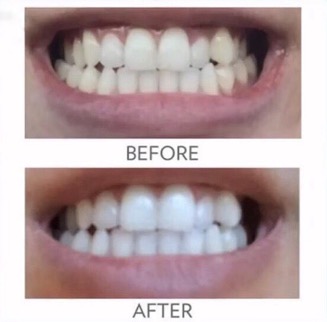 whitening_toothpaste_before_after